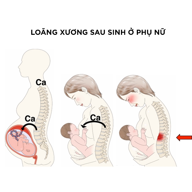 Lý do dẫn đến loãng xương sau sinh và cách phòng ngừa