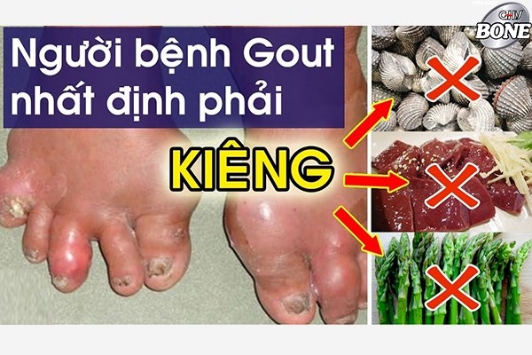 Người bệnh gout tránh ăn gì?