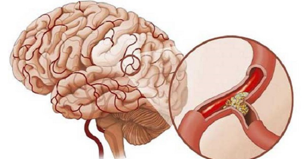 Thời tiết lạnh, làm gì để phòng ngừa tai biến mạch máu não?