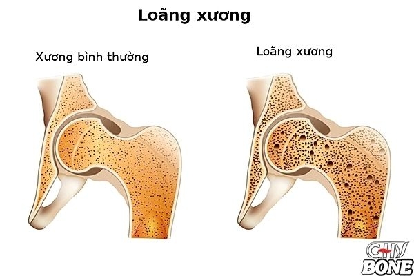 Hệ lụy khi thiếu hụt canxi