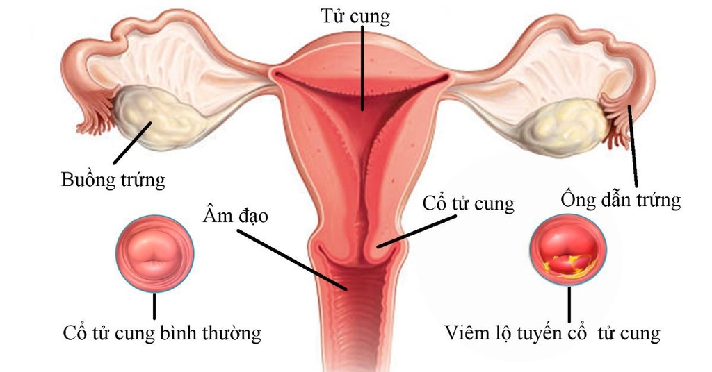 Các bệnh dễ mắc ở tử cung