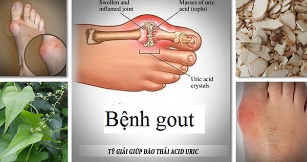 Thuốc và món ăn hỗ trợ trị bệnh gút