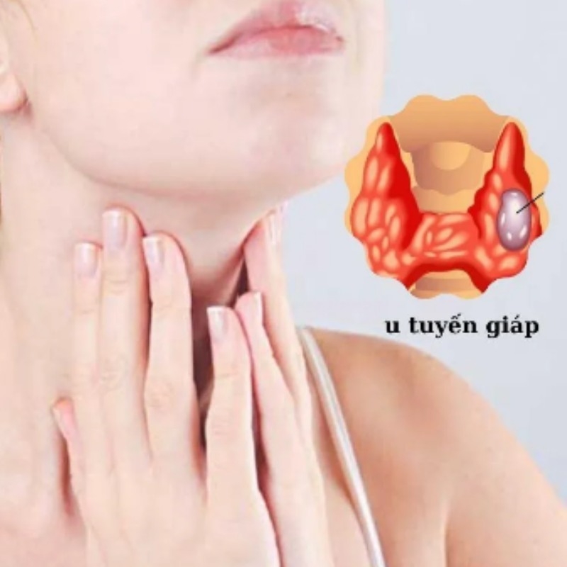 8 loại thực phẩm tốt cho người bệnh ung thư tuyến giáp
