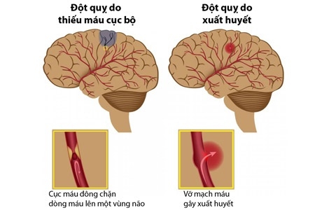 10 dấu hiệu tai biến mạch máu não