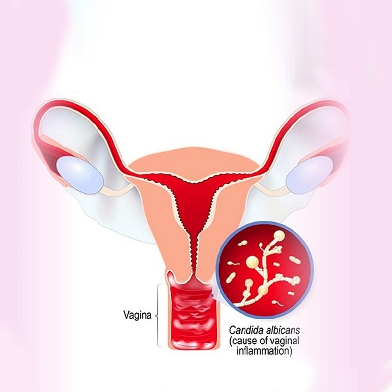 Vì sao viêm âm đạo xử lý mãi không dứt?