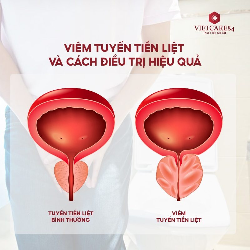 Viêm Tuyến Tiền Liệt Và Cách Điều Trị Hiệu Quả - Nutri Prostate Support