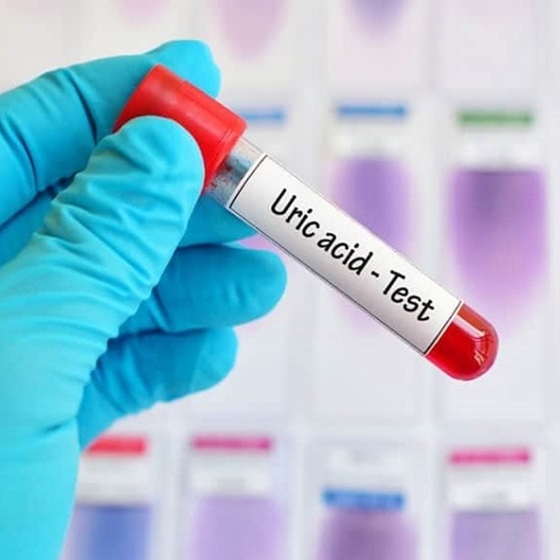 Ý nghĩa việc xét nghiệm acid uric máu và giải pháp khi acid uric tăng
