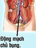 Phình động mạch chủ bụng ở người cao tuổi