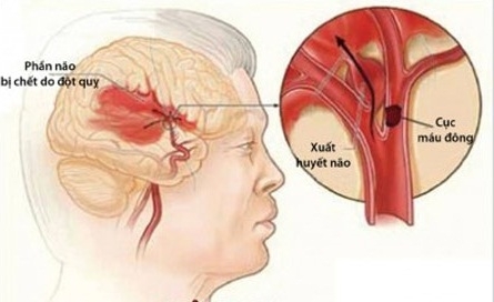 Phòng ngừa đột quỵ não khi trời lạnh giá
