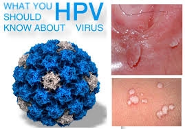 Ðàn ông chớ coi thường HPV
