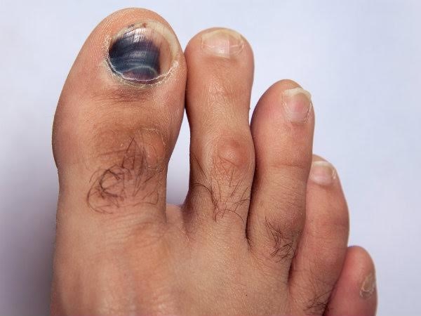 9 triệu chứng ở móng cho biết tình trạng sức khỏe của bạn