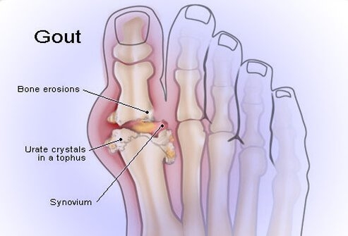 Chữa gút bằng cây lá trong vườn