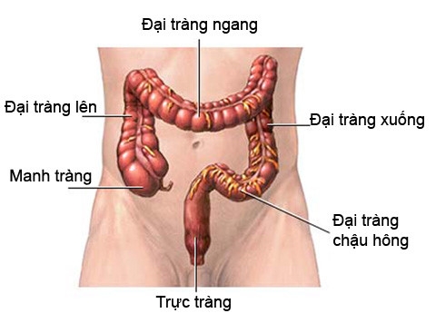 Tắc ruột do u đại tràng