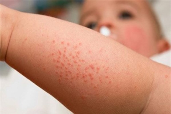 5 cách đối phó với ban nhiệt ở trẻ vào mùa hè