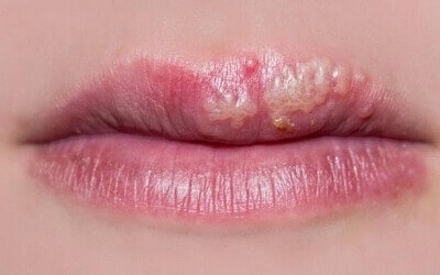 4 thực phẩm làm nặng thêm vết loét herpes quanh miệng