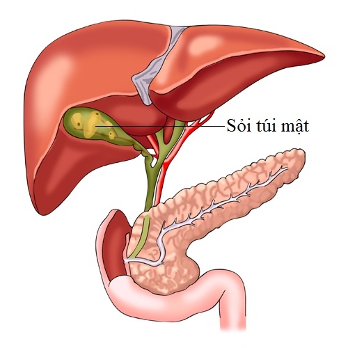 Cách phòng ngừa sỏi túi mật