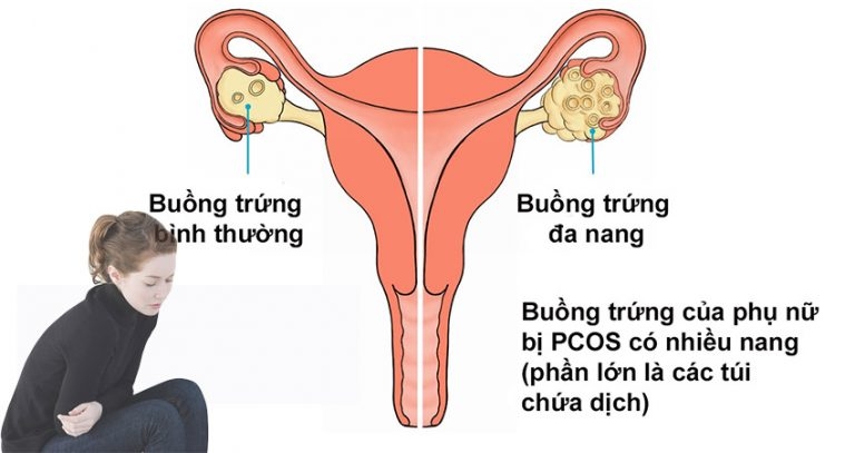 Buồng trứng đa nang và nguy cơ hiếm muộn