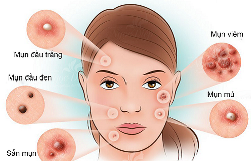 Một số bài thuốc trị mụn trứng cá