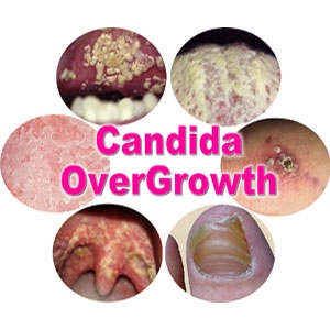 Mắc nấm Candida sinh dục, có chữa khỏi?