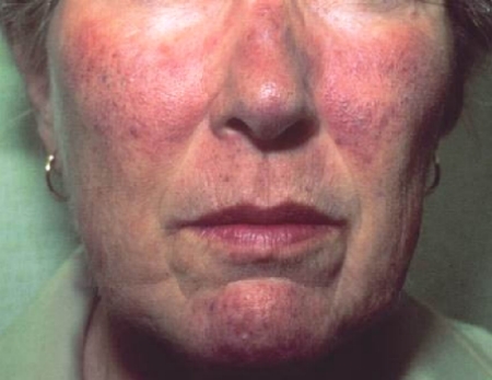 Hội chứng carcinoid có nguy hiểm?