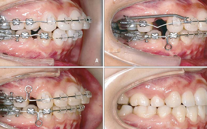 Niềng răng, những điều chưa biết