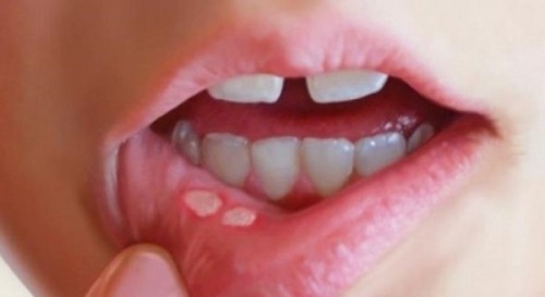 NGUYÊN NHÂN CỦA BỆNH LỞ MIỆNG VÀ MẸO DÂN GIAN CHỮA LỞ MIỆNG CỰC HAY