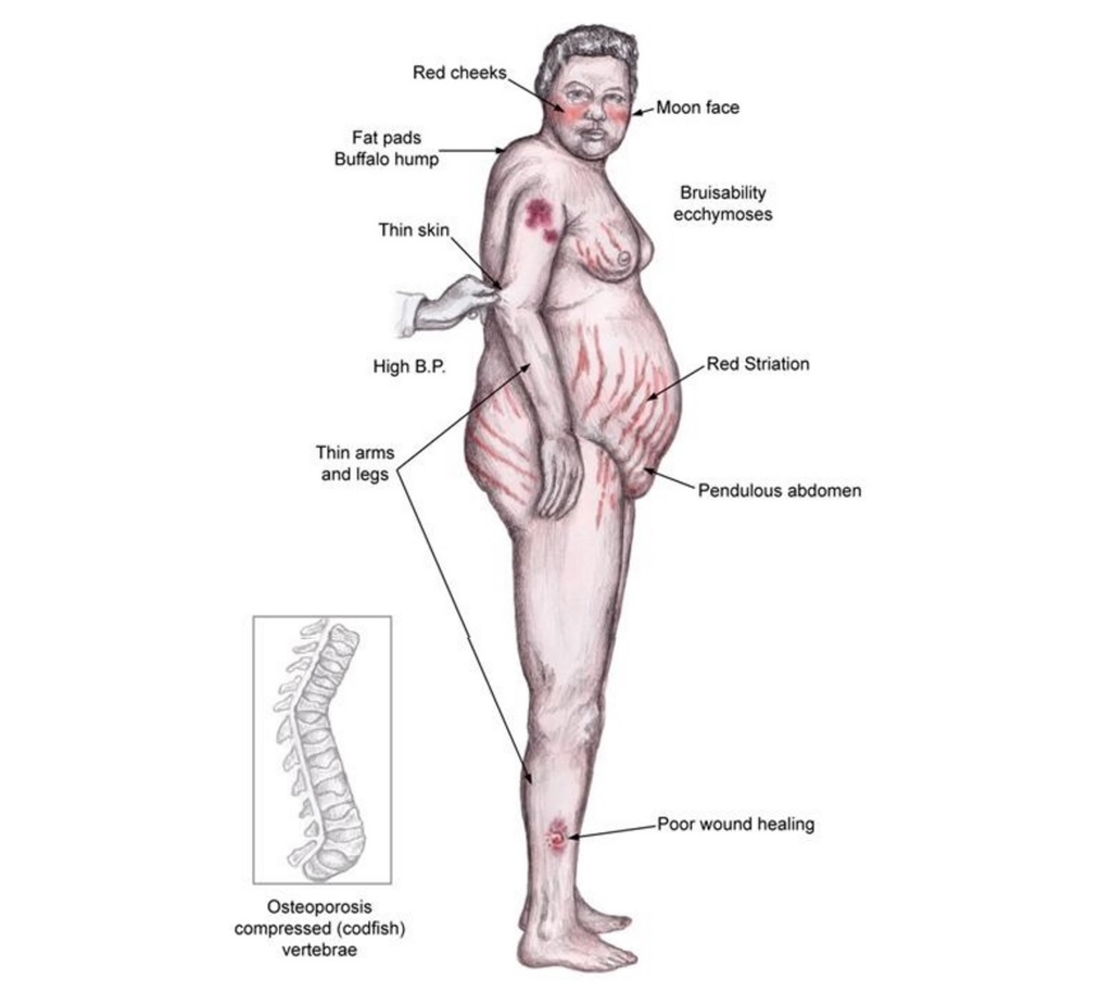 Hội chứng Cushing – bệnh lý thường gặp