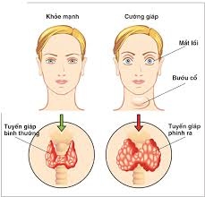 Món ăn tốt cho người bị bướu cổ