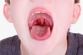 Cách nhận biết ung thư vòm họng