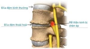 Tần suất bị thoái hóa đĩa đệm cột sống rất cao