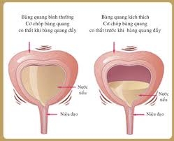 Chủ động chặn nhiễm trùng bàng quang