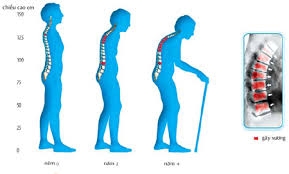 Những kẻ “chủ mưu” gây loãng xương