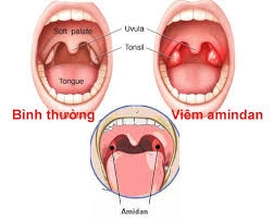 Bệnh viêm V.A mạn tính
