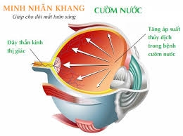 Bệnh cườm nước
