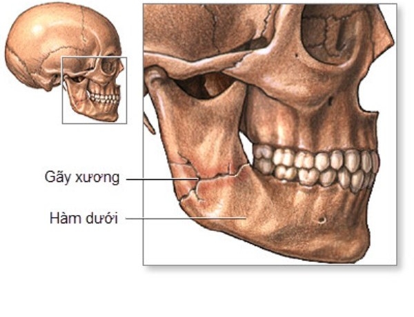 Nhận biết rối loạn khớp thái dương hàm