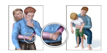 CÁCH XỬ TRÍ DỊ VẬT