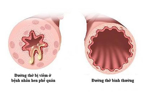 Ảnh hưởng của bệnh hen tới tình dục