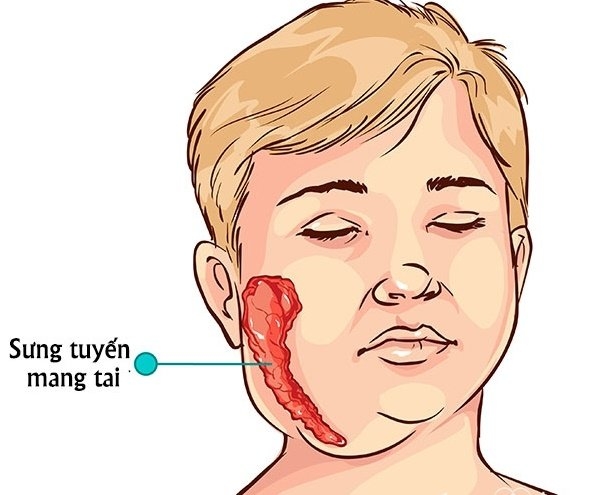 Các thể lâm sàng của bệnh quai bị