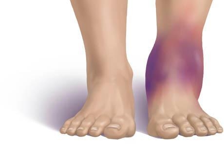 Xử trí khi bị bong gân
