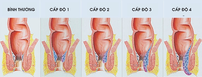 Nhận biết bệnh trĩ