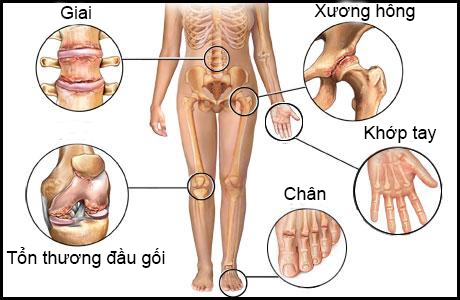 Bệnh cơ xương khớp - Nguyên nhân hàng đầu gây tàn phế