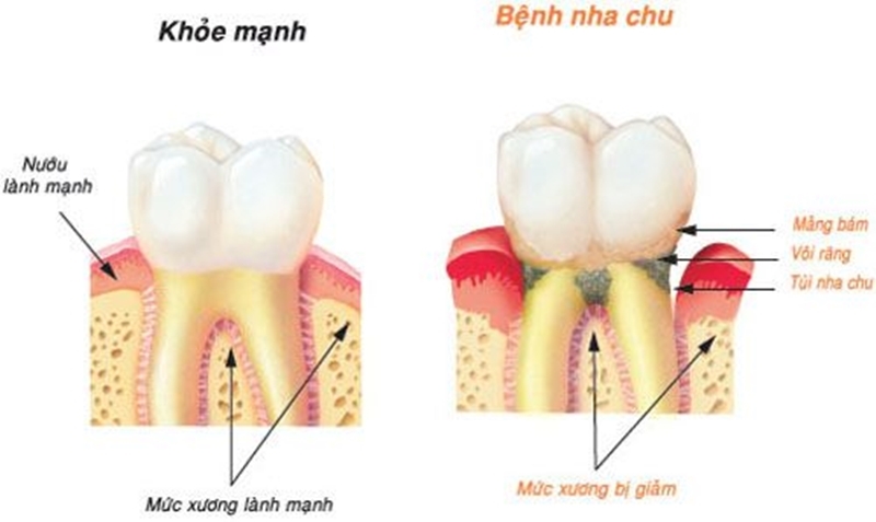 Bệnh nha chu và cách phòng ngừa