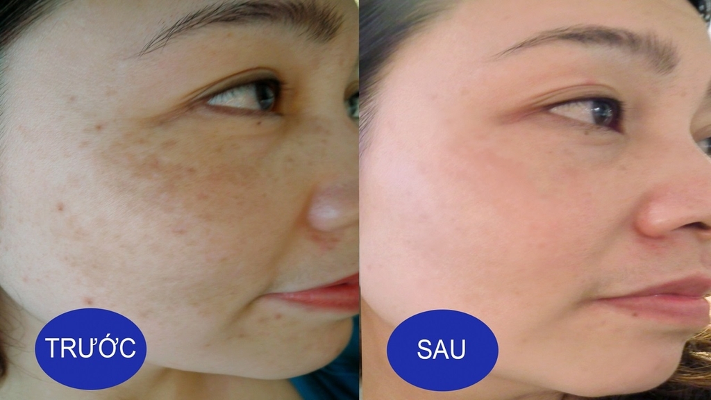 Bác sĩ da liễu tư vấn cách hạn chế sạm da, nám má trong mùa hè