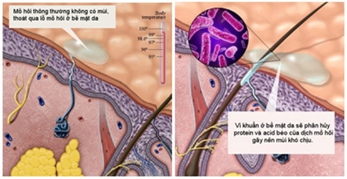 Những người dễ bị viêm tuyến mồ hôi