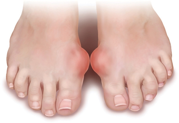 5 món ăn thích hợp với người bị thống phong