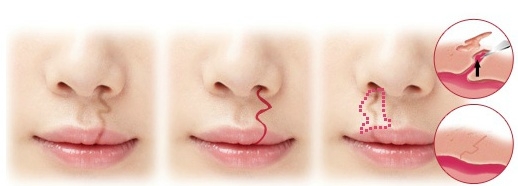 Sứt môi, hở vòm: căn bệnh cần 18 - 20 năm điều trị