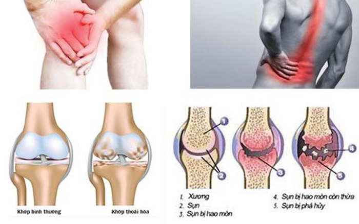 Bệnh xương khớp: Nguyên nhân và triệu chứng