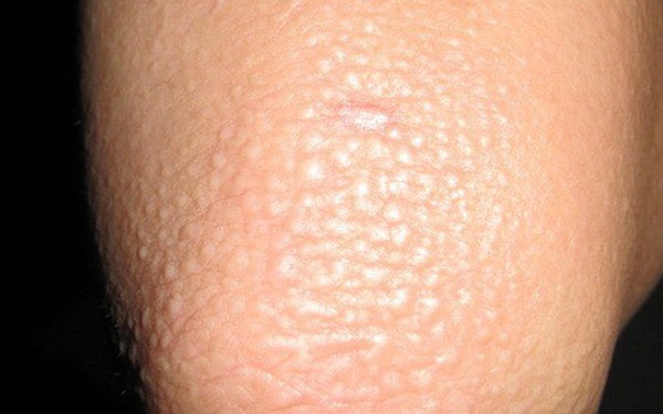 Thoái hóa nhầy - Bệnh gì?
