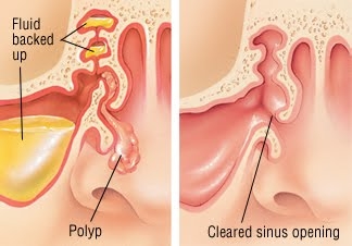 Polyp mũi có nguy hiểm?