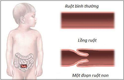 4 dấu hiệu chứng tỏ trẻ bị lồng ruột, cha mẹ cần lưu ý